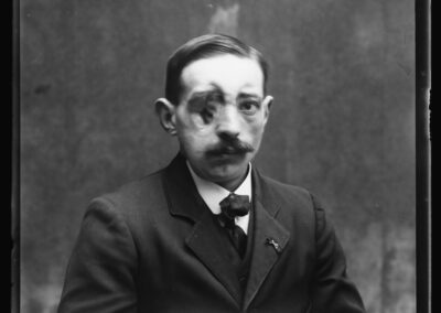 Negatyw - fotografia przedstawiająca francuskiego żołnierza, którego twarz została okaleczona podczas I wojny światowej, 06.12.1918 r., Biblioteka Kongresu USA