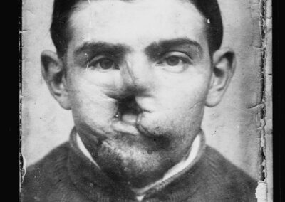 Negatyw - fotografia przedstawiająca francuskiego żołnierza, którego twarz została okaleczona podczas I wojny światowej, 17.10.1918 r., Biblioteka Kongresu USA